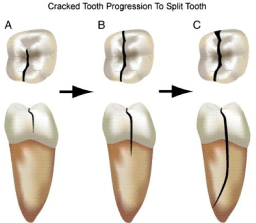 Gum Fractures Houston TX