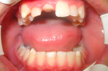 Subgingival Fractures | Periodontist Houston TX | 77063