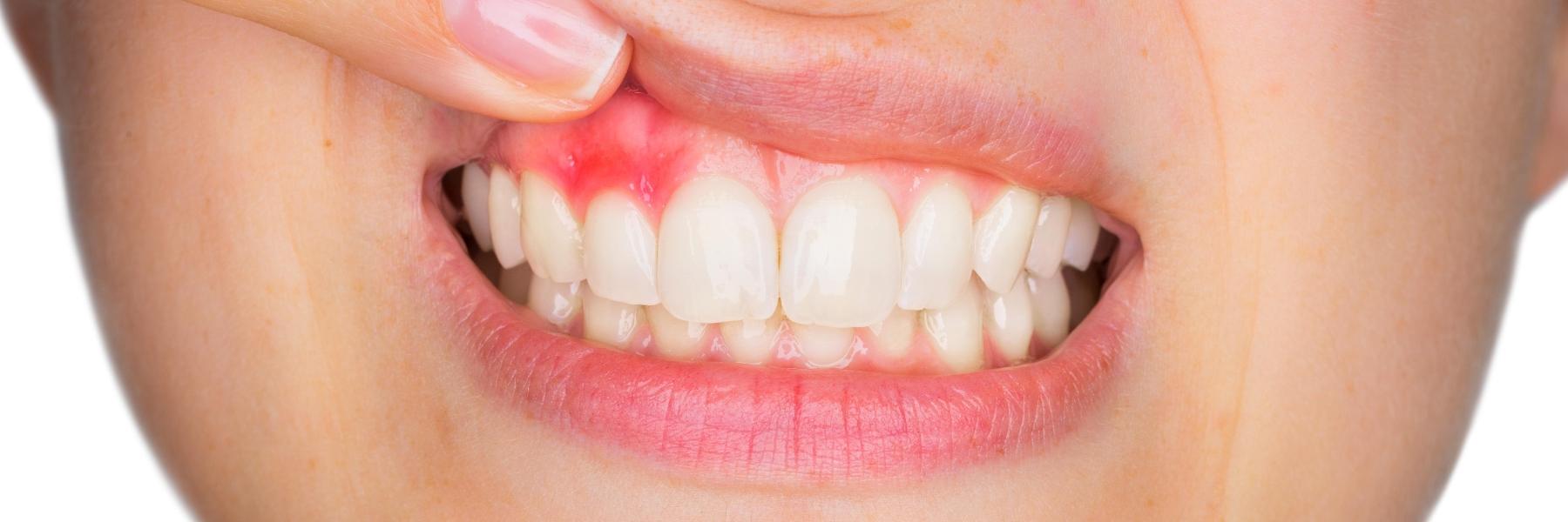 5 Things You Should Know About Gum Disease