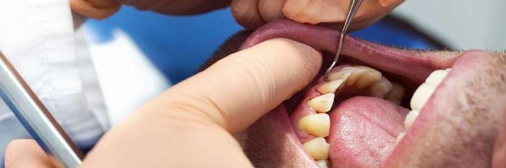 6 Types of Periodontal Disease